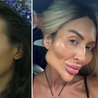 Dalam salah satu unggahannya di Instagram, Anastasia memperlihatkan perbedaan sebelum dan sesudah filler pipi. “Menemukan foto usia 26 dan 35. Tidak ada hyaluronic acid di foto pertama,” keterangan fotonya. Foto: dok. Instagram @ justqueen88