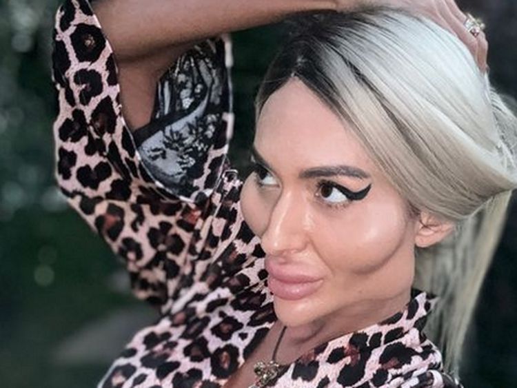 Foto Before After Wanita Pemilik Pipi Terbesar di Dunia, Dulu Tampil Normal