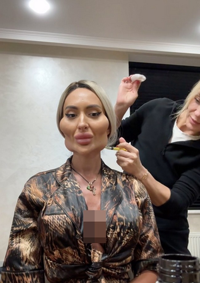 Selebgram itu terus membagikan perkembangan operasinya secara daring, dan dalam sebuah unggahan tahun lalu yang menampilkan hasil operasinya. Anastasia pun terus ingin membesarkan pipinya. Semua kecantikan yang kalian lihat adalah hasil karya @plastikaistanbul_. Tapi aku ingin sedikit lagi.” Foto: dok. Instagram @ justqueen88