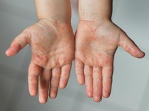 Anak Mengidap Flu Singapura, Boleh Mandi Nggak Sih? Begini Kata Dokter