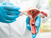 Viral Ramuan Detoks Rahim untuk Cegah Kista, Emang Ngaruh? Ini Kata Obgyn