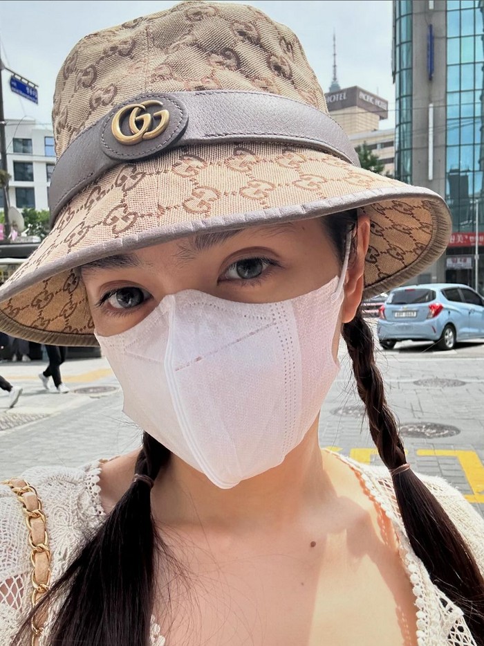 Angel Karamoy setelah operasi plastik.