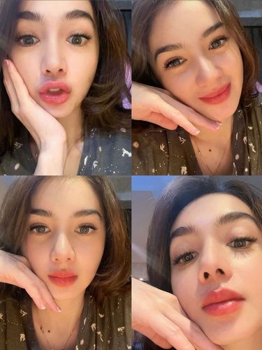 Angel Karamoy Wajah Angel Karamoy dua bulan setelah operasi plastik.