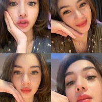 Angel Karamoy menjalani operasi plastik rhinoplasty di sebuah klinik kecantikan di Seoul, Korea Selatan. Alasannya melakukan rhinoplasty untuk merekonstruksi bentuk hidung yang sedikit bengkok dan menonjol. Foto: Instagram @realangelkaramoy