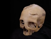 Pengobatan Kanker Zaman Kuno Terungkap Lewat Tengkorak Berusia 4.000 Tahun