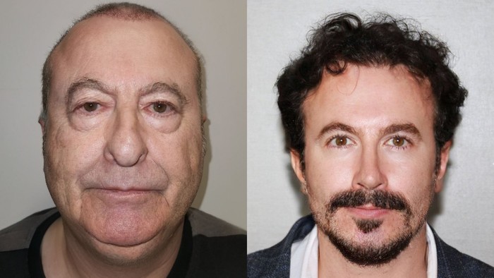 Viral penampilan pria operasi plastik