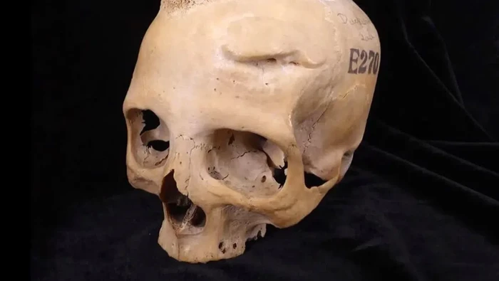 Tengkorak Kepala Ini Jadi Bukti Kanker Sudah Ada Sejak 4 Ribu Tahun Lalu