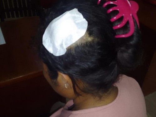 Perempuan di Sumba Barat dipukul pakai knalpot motor.