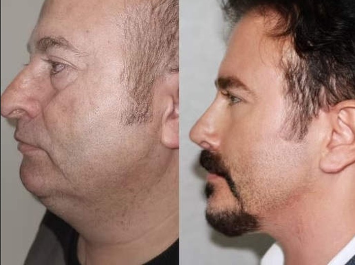 before after kakek dan nenek