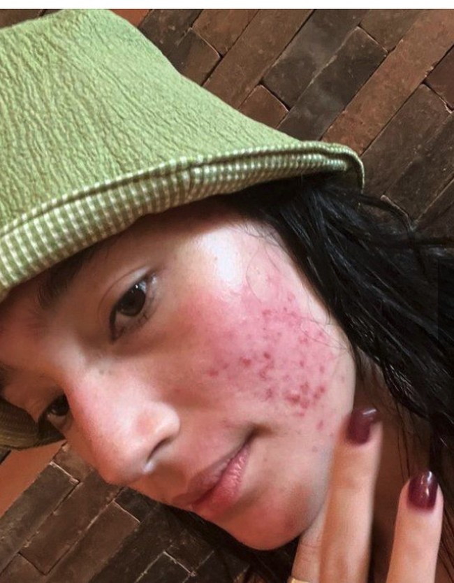 Lalu ada Tatjana Saphira yang berbagi kisah perjuangannya melawan jerawat selama 10 tahun. Bahkan ia tampil bare face memperlihatkan jerawatnya saat sedang meradang kala itu. Foto: Instagram 