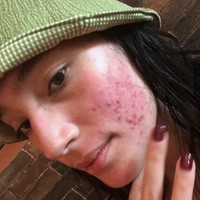Lalu ada Tatjana Saphira yang berbagi kisah perjuangannya melawan jerawat selama 10 tahun. Bahkan ia tampil bare face memperlihatkan jerawatnya saat sedang meradang kala itu. Foto: Instagram 