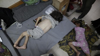 Potret Pilu Anak-anak Palestina Menderita Malnutrisi Akut