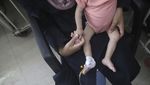 Potret Pilu Anak-anak Palestina Menderita Malnutrisi Akut