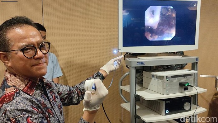 Metode RIRS untuk Pengobatan Batu Ginjal, Minim Invasif-Pasien Cepat Pulih