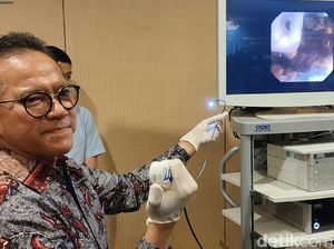 Metode RIRS untuk Pengobatan Batu Ginjal, Minim Invasif-Pasien Cepat Pulih