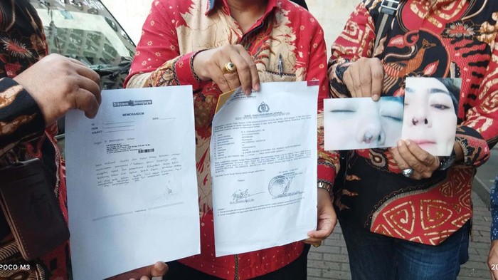 Korban Dugaan Malpraktek Datangi Polda Metro Jaya Korban dugaan malpraktek operasi filler hidung di salah satu klinik datangi Polda Metro Jaya. Ia menanyakan perkembangan perkambangan laporan kasus tersebut.