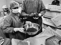 Awal Mula Pria 30-an Idap Tumor Testis Raksasa 40 Cm, Begini Kondisinya