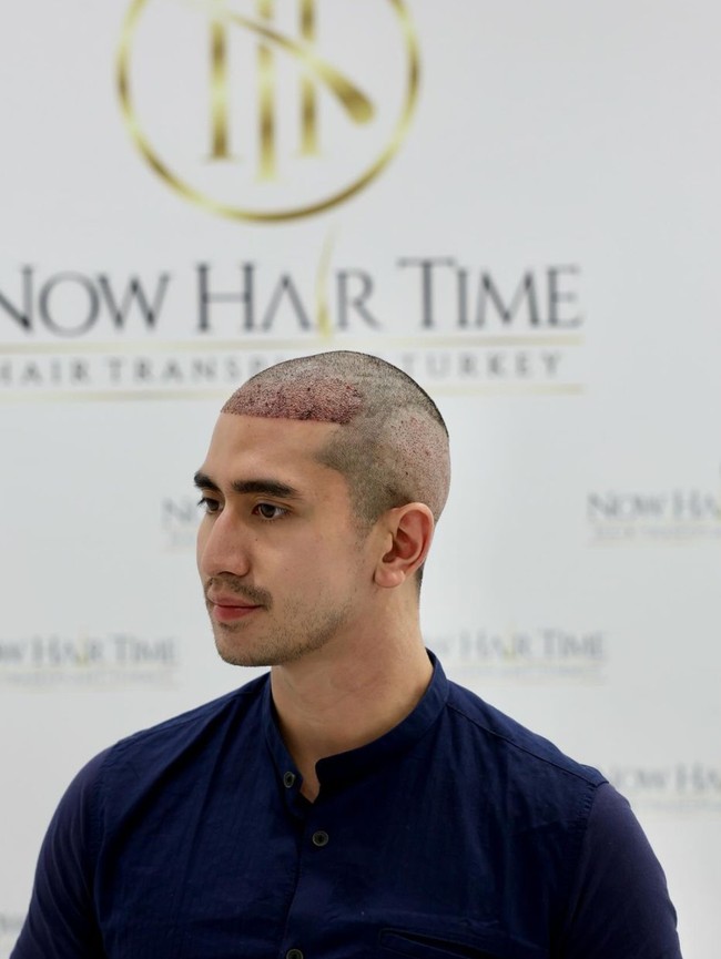 Dalam keterangan unggahannya Verrel mengaku jika dirinya memilih tanam rambut karena merasa garis rambutnya sudah mulai ke belakang dan tidak rata. Hal tersebut bisa diakibatkan karena Verrel kerap menggunakan banyak produk rambut, seperti,gel, wax, ataupun hairspray. Foto: Instagram/@bramastavrl