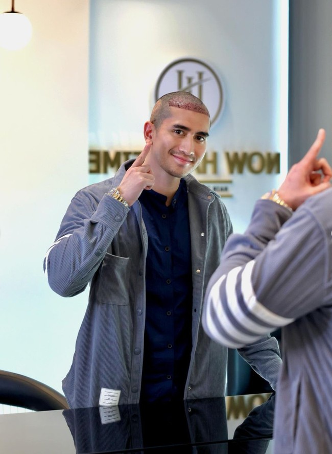 Melalui akun Instagram pribadinya Verrel membagikan foto penampilan terbarunya yang kini berkepala botak. Verrel dikeahui rela memangkas rambutnya demi menjalani proses tanam rambut di Istanbul, Turki. Foto: Instagram/@bramastavrl