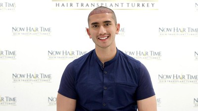 5 Potret Verrell Bramasta Usai Transplantasi Rambut di Turki