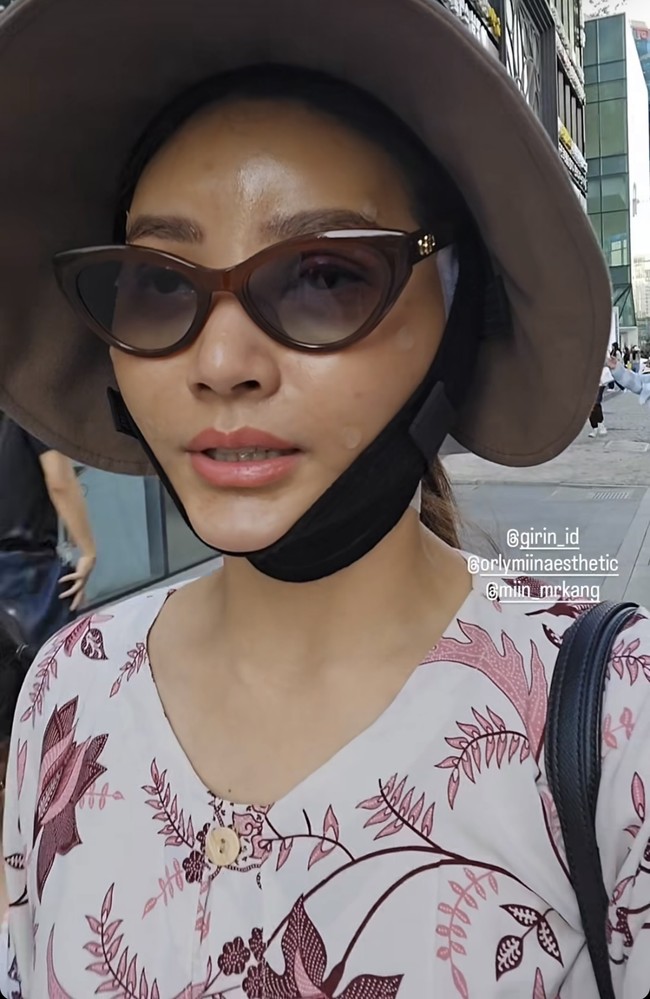 Di hari kedua bengkak di bagian pipi Sarwendah mulai terlihat berkurang. Namun bengkaka di bagian lipatan matanya masih terlihat jelas. Foto: Instagram/@sarwendah29