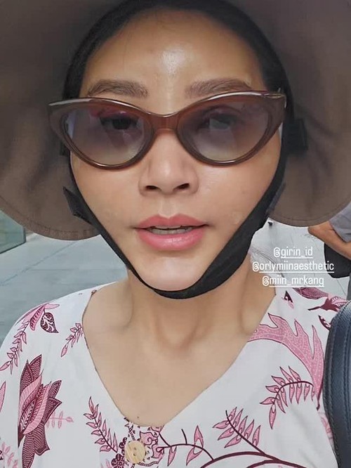 Sarwendah usai operasi plastik di Korea.