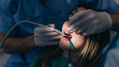 Ilustrasi scaling gigi