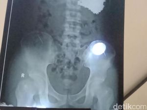 Halusinasi Bertubuh Sakti Bikin Pria Indramayu Telan 70 Paku