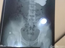 5 Fakta Terbaru di Balik Paku Bersarang di Tubuh Pria Indramayu