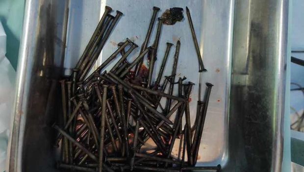Penampakan paku yang sempat bersarang di tubuh pemuda Indramayu