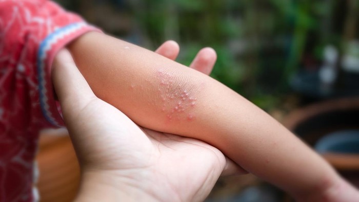 Flu singapura
