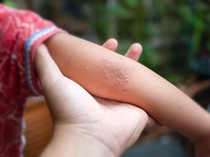 7 Anak di Pulang Pisau Terjangkit Flu Singapura Selama Mei-Juni