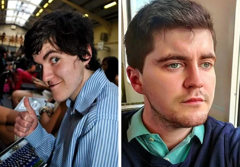 Foto Sebelum dan Sesudah Operasi Plastik