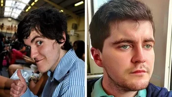 Pria ini menjalani operasi untuk memperbaiki underbite, dan berat badannya turun banyak Foto: Brightside