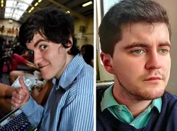 Foto Sebelum dan Sesudah Operasi Plastik Bikin Tercengang