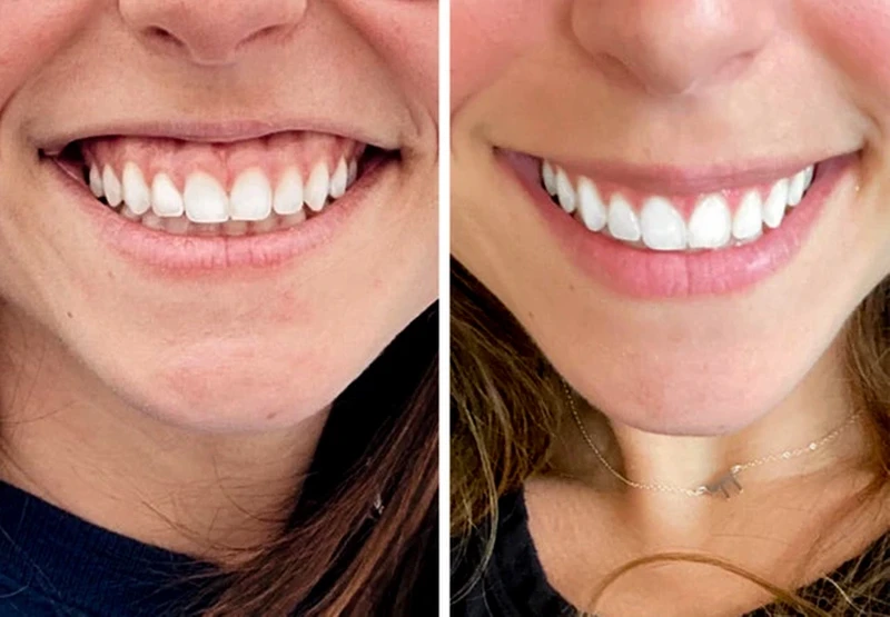 Foto Sebelum dan Sesudah Operasi Plastik