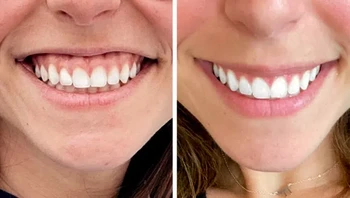 Wanita ini memilih Botox untuk memperbaiki senyumnya Foto: Brightside