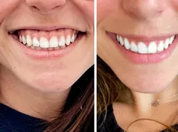 Foto Sebelum dan Sesudah Operasi Plastik Bikin Tercengang