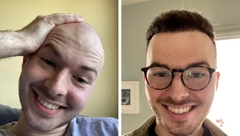 Potret 6 bulan setelah transplantasi rambut Foto: Brightside