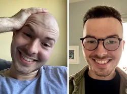 Foto Sebelum dan Sesudah Operasi Plastik Bikin Tercengang