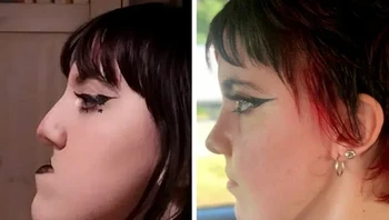 Foto perbandingan setahun sebelum dan sesudah operasi reposisi rahang atas dan bawah.Foto: Brightside