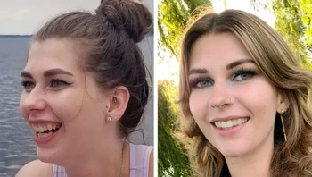 Wanita ini menjalani kawat gigi dan operasi rahang ganda untuk memperbaiki masalah gigi dan kerangka. Foto: Brightside