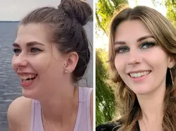 Foto Sebelum dan Sesudah Operasi Plastik Bikin Tercengang