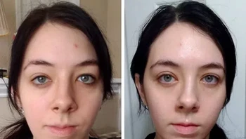 2 bulan pasca operasi blepharoplasty dan canthopexy lateral Foto: Brightside