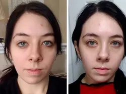 Foto Sebelum dan Sesudah Operasi Plastik Bikin Tercengang