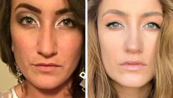 Sebelum dan setahun setelah operasi hidung Foto: Brightside