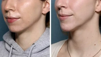 Sebelum genioplasti geser dan 5 bulan pascaoperasi Foto: Brightside