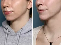 Foto Sebelum dan Sesudah Operasi Plastik Bikin Tercengang