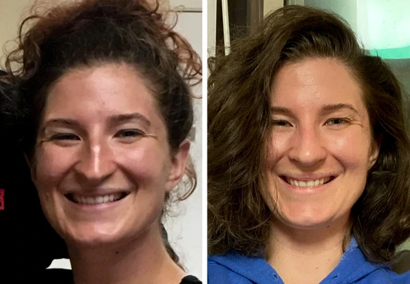 Foto Sebelum dan Sesudah Operasi Plastik