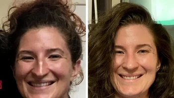 Perbandingan sebulan dan 6 minggu setelah operasi hidung Foto: Brightside